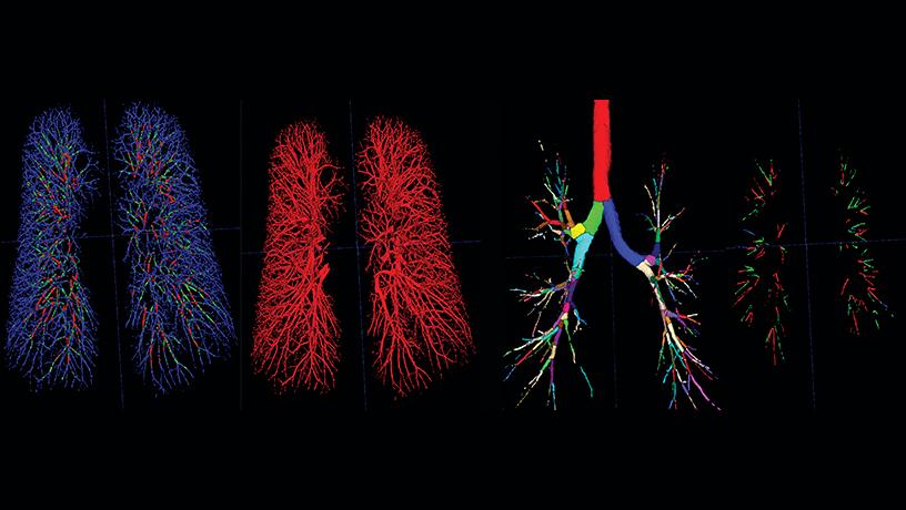 thoracic high-resolution computed tomography